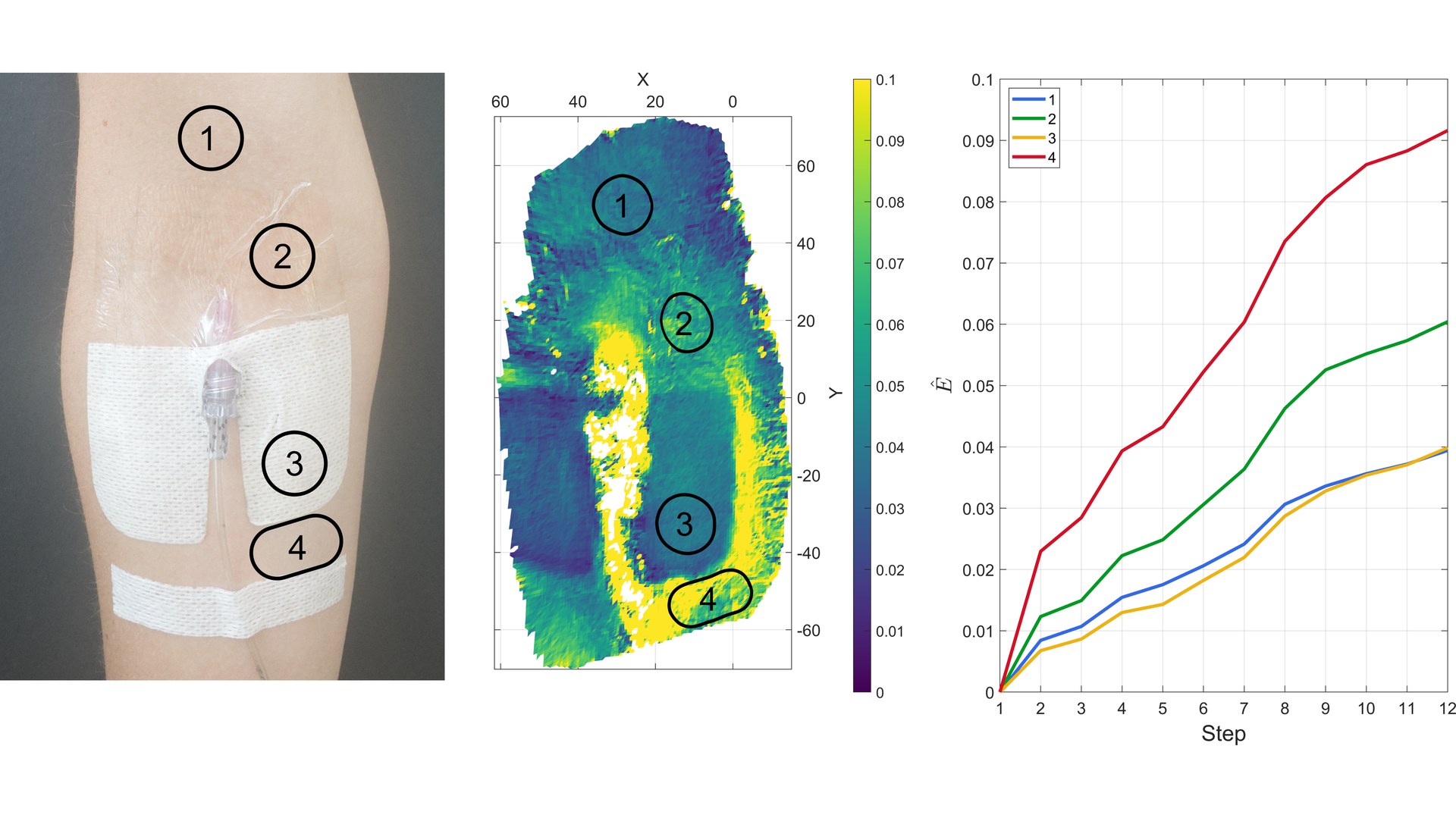 Full-field skin strain measured around an IV catheter dressing